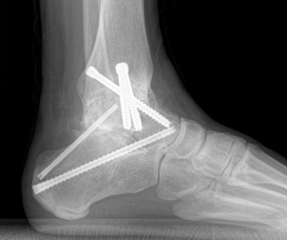 An x-ray showing a foot after hind foot arthritis surgery