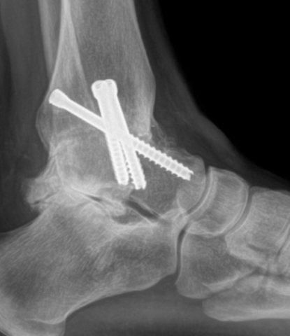 An x-ray showing a foot before hind foot arthritis surgery