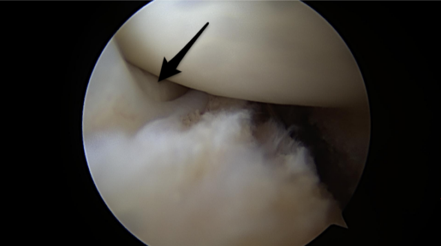 Articular cartilage in view in a hip labrum