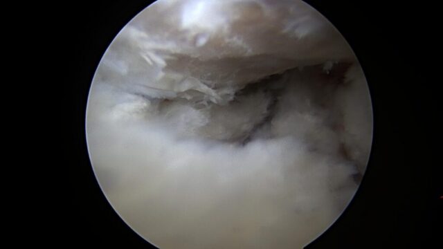 An arthroscopically repaired labral tear