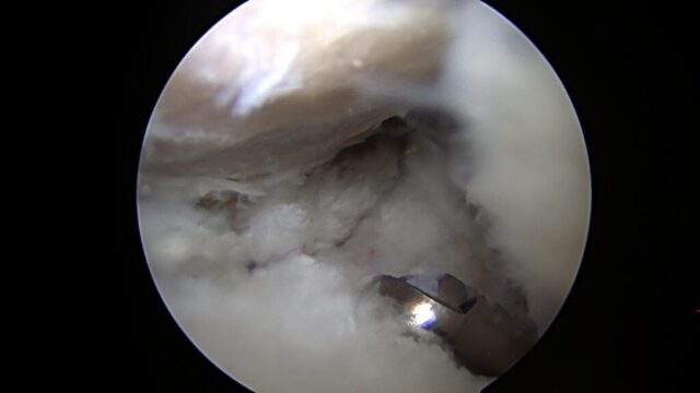 Arthroscopic surgery to repair a complex labral tear