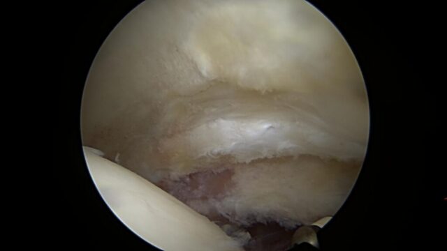 The same labrum following the debridement
