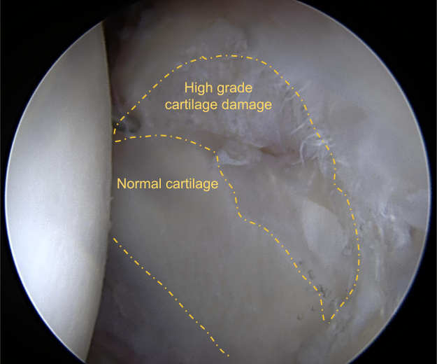 Severe cam-type impingement in a hip