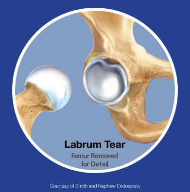 Acetabular Labrum Tear
