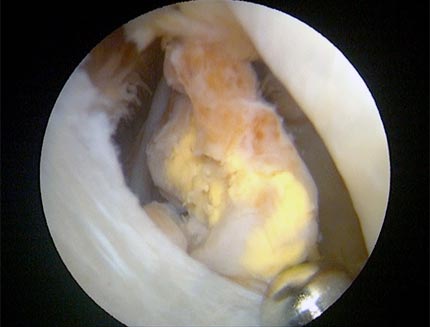 Nodule of diseased PVNS which was removed during hip arthroscopy